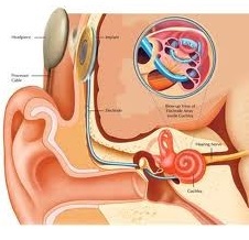 การผ่าตัดประสาทหู