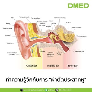 ทำความรู้จักกับการ "ผ่าตัดประสาทหู"