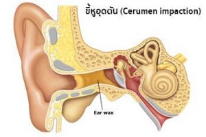 ขี้หูอุดตัน...ทำอย่างไรดี?